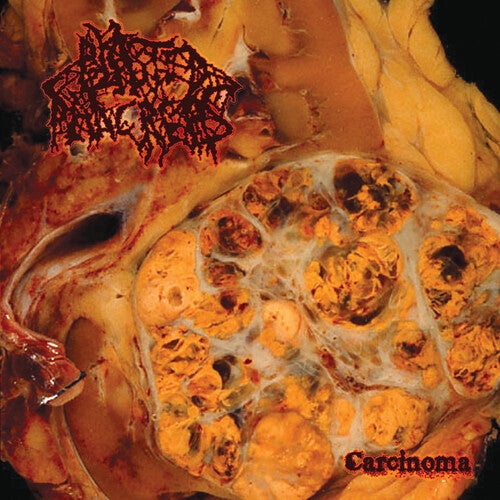 Blasted Pancreas: Carcinoma - CD